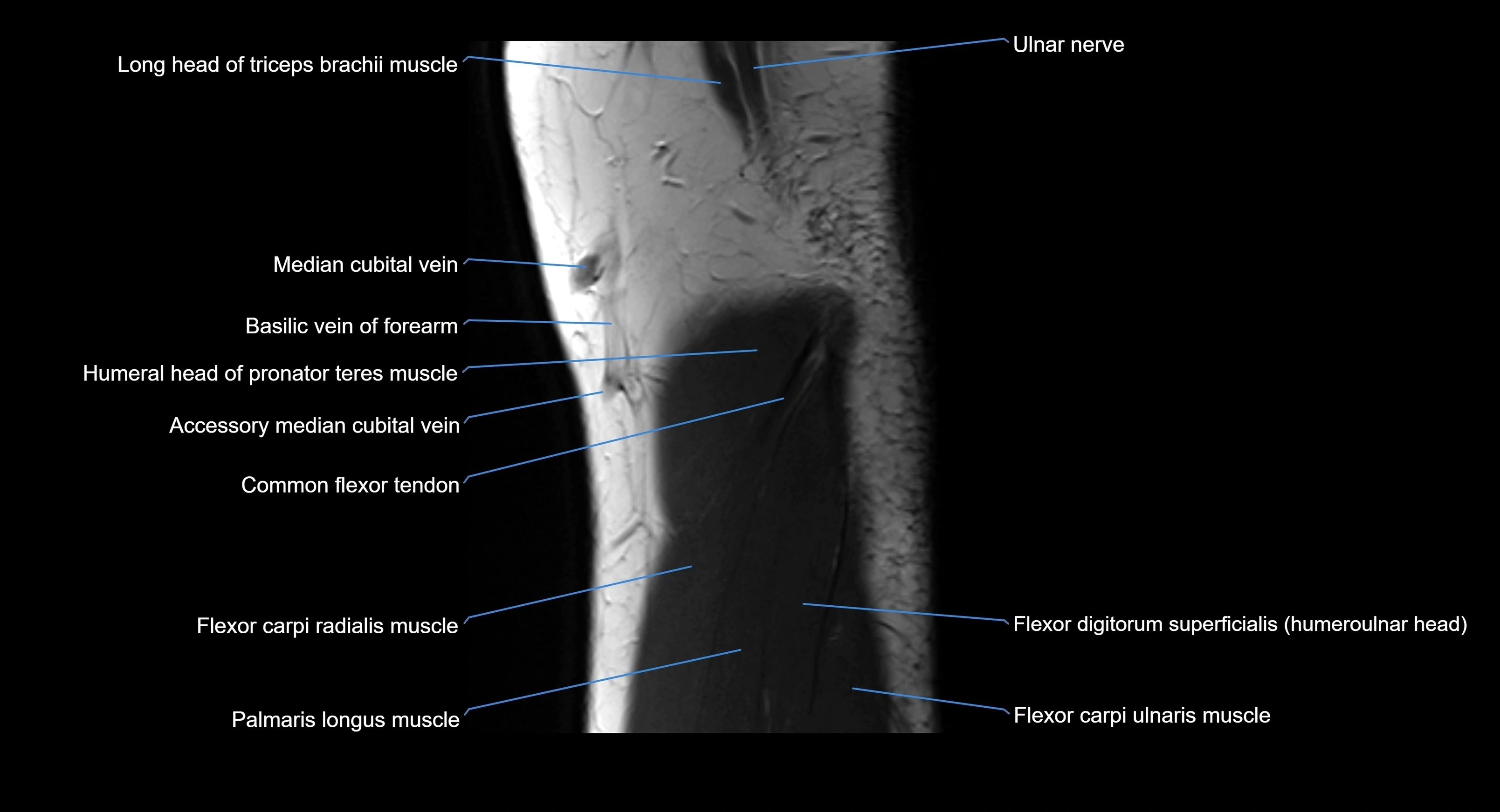MRI elbow joint  sagittal cross sectional anatomy 3T  radiology  image-img-00001-00006.webp